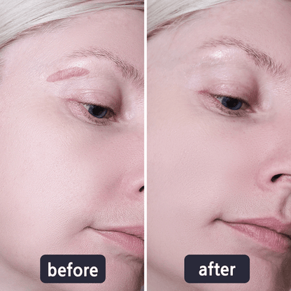 💥50% OFF💥LBMLBM™ Medical-Grade Silicone Scar Gel