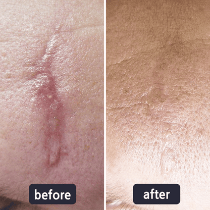 💥50% OFF💥LBMLBM™ Medical-Grade Silicone Scar Gel
