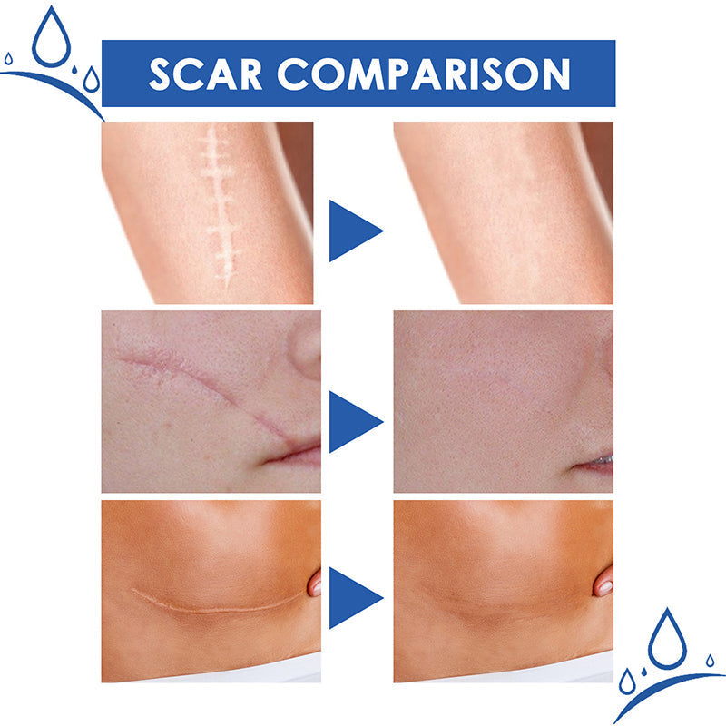 𝑶𝒇𝒇𝒊𝒄𝒊𝒂𝒍 𝑺𝒕𝒐𝒓𝒆 | LBMLBM® Science-Backed Scar Removal Cream: Restore Your Skin’s Natural Texture in as little as 4 Weeks