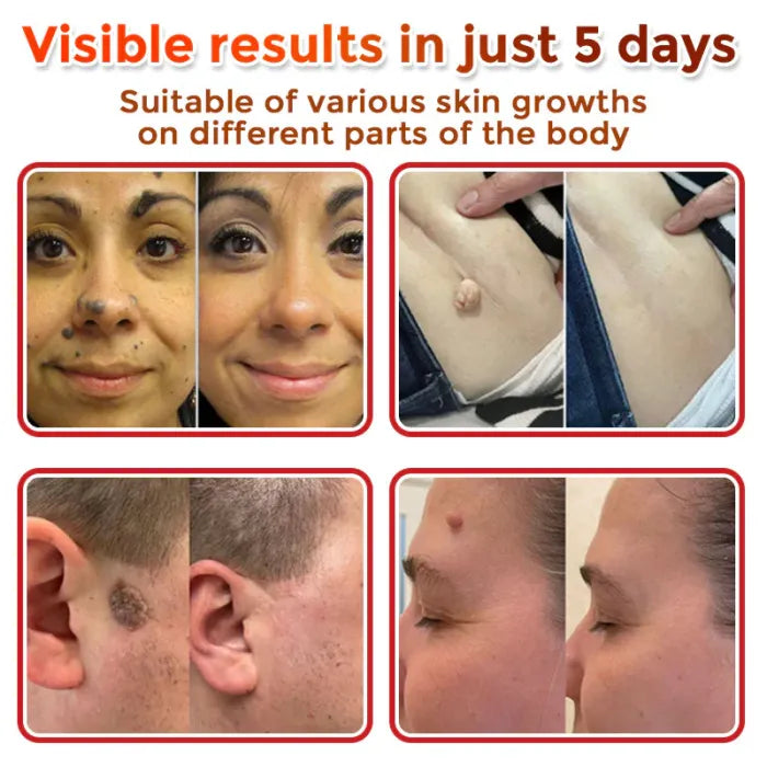 👩‍⚕️𝑶𝒇𝒇𝒊𝒄𝒊𝒂𝒍 𝑺𝒕𝒐𝒓𝒆 | ODALIT™ Gentle Microneedle Patches for Skin Tag & Mole Removal